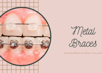 Metal Braces